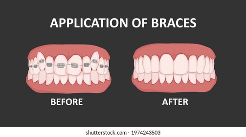 Braces on teeth, before and after. Orthodontic treatment. Crooked teeth. Dental concept.