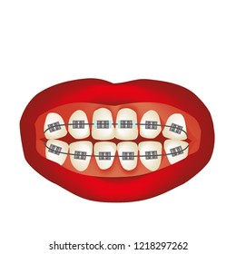 Braces on the teeth. Infographics. Vector illustration on isolated background.