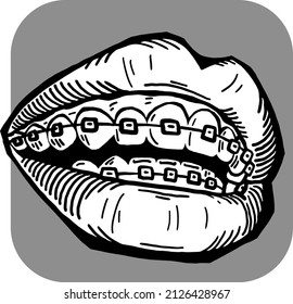 Braces on the teeth. Medical dentist checkup in dental clinic. Tooth correction with brackets. Open mouth showing healthy teeth and gums. Hand drawn vintage vector illustration. Old style drawing.