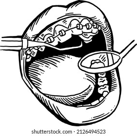 Braces on the teeth. Medical dentist checkup in dental clinic. Tooth correction with brackets. Open mouth showing healthy teeth and gums. Hand drawn  vintage vector illustration. Old style drawing.