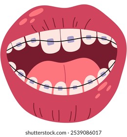 Aparelhos nos dentes.  Boca aberta com aparelho. Estilo de vida saudável e cuidados dentários.