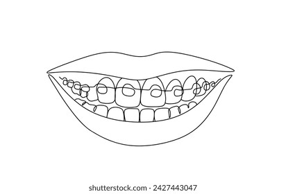 Ortesis en los dientes. Un diseño de ortodoncia utilizado para enderezar los dientes, corregir las mordeduras y crear una hermosa sonrisa. Vector. Imágenes producidas sin el uso de ningún tipo de software de IA en ninguna etapa. 