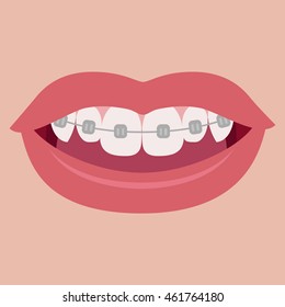 Braces on teeth. Vector illustration