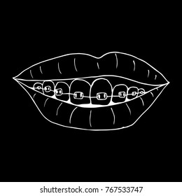 Braces on teeth vector illustration. Doodle style. Design, print, decor, textile, paper