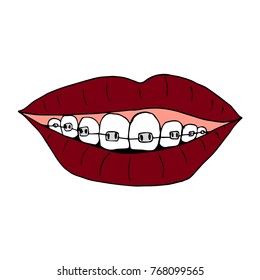 Braces on teeth vector illustration. Doodle style. Design, print, decor, textile, paper