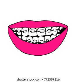 Braces on teeth vector illustration. Doodle style. Design, print, decor, textile, paper