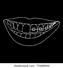 Braces on teeth vector illustration. Doodle style. Design, print, decor, textile, paper