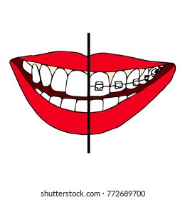Braces on teeth vector illustration. Doodle style. Design, print, decor, textile, paper