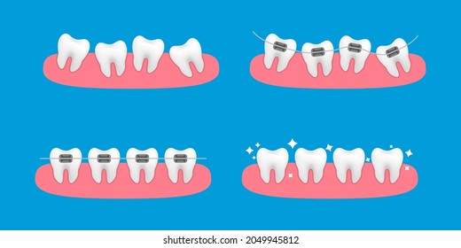 Braces on the teeth. White clear teeth with ceramic braces. Orthodontic treatment stages. Alignment of teeth and bite correction with the help of braces system. Vector Illustration