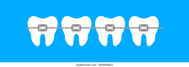 Braces on the teeth. White clear teeth with ceramic braces. Orthodontic treatment stages. Alignment of teeth and bite correction with the help of braces system. Vector Illustration