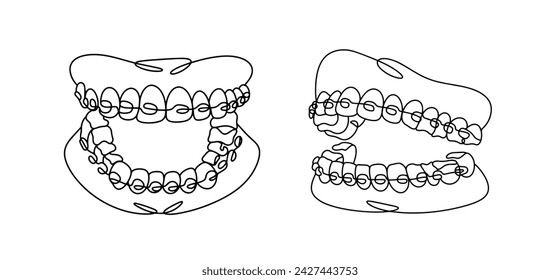 Zahnspangen am Ober- und Unterkiefer. Ein kieferorthopädisches Design, um Zähne zu glätten und Bisse zu korrigieren. In: World Oral Health Day. Bilder, die ohne Verwendung irgendeiner Form von KI erstellt wurden. 