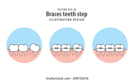 Braces teeth step in circle illustration vector on white background. Dental concept.