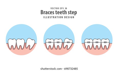 Braces teeth step in circle illustration vector on white background. Dental concept.