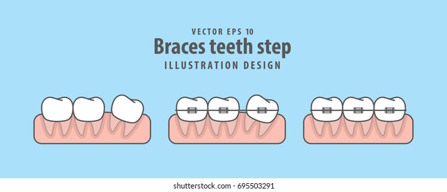 Braces teeth step illustration vector on blue background. Dental concept.