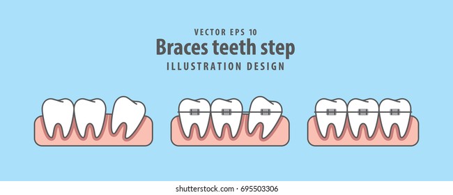 Braces teeth step illustration vector on blue background. Dental concept.