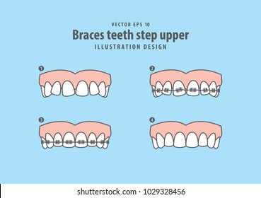 Braces teeth step upper illustration vector on blue background. Dental concept.