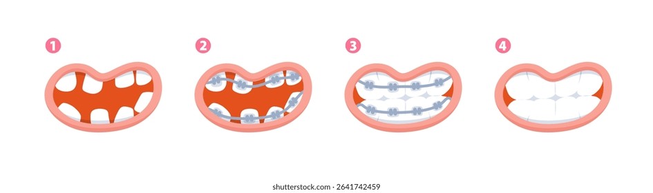 Braces teeth steps from diastema teeth to healthy teeth illustration vector design on white background. Dental care concept.