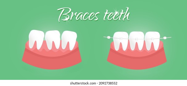 Braces teeth.Dental concept.flat vector illustration of the rules for teeth alignment