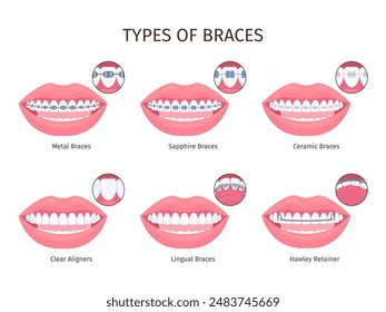 Braces types. Dental bracket teeth retainer type, metalic plastic ceramic invisible sapphire brace aesthetic tooth mouth, orthodontic aligner infographic swanky vector illustration