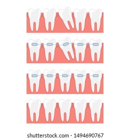 Braces vector design illustration isolated on white background