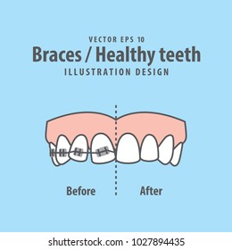 Braces-Healthy teeth illustration vector on blue background. Dental concept.