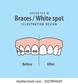 Braces-White spot illustration vector on blue background. Dental concept.