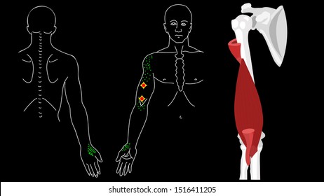 Brachialis muscle. Trigger points in the arm