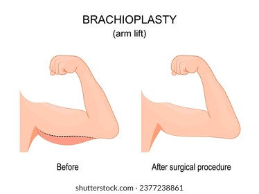 Brachioplastia. Antes y después del procedimiento quirúrgico. Levantamiento de brazos. Vista frontal. Cirugía estética. Ilustración del vector