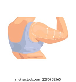Brachioplasty illustration in color cartoon style. Editable vector graphic design.