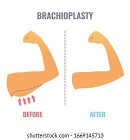 Brachioplasty medical infographic poster. Before and after result of arm lift aesthetic surgery. Body contouring procedure. Healthcare and medical concept. Vector illustration.