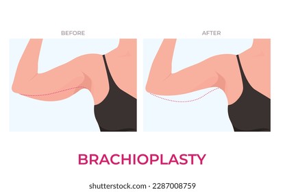 Brachioplasty or Upper Arm Lift plastic surgery in woman. Front view