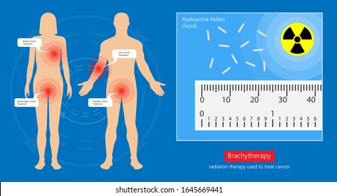 Brachytherapy Treat Vagina Cell CT Scan MRI Cervix Seed Radiotherapy Iodine Pelvic Episcleral Implant