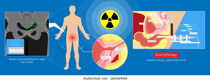 Brachytherapy Treat Vagina Cell Ct Scan Stock Vector Royalty Free 1645669444 Shutterstock 7238