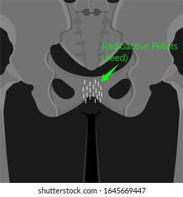 Brachytherapy Treat Vagina Cell CT Scan MRI Cervix Seed Radiotherapy Iodine Pelvic Episcleral Implant