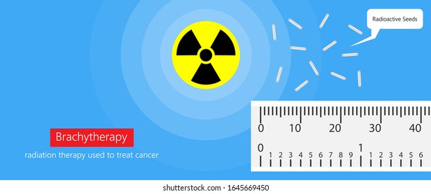 Brachytherapy Treat Vagina Cell CT Scan MRI Cervix Seed Radiotherapy Iodine Pelvic Episcleral Implant