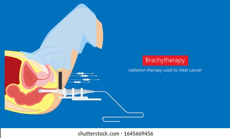 Brachytherapy Treat Vagina Cell CT Scan MRI Cervix Seed Radiotherapy Iodine Pelvic Episcleral Implant