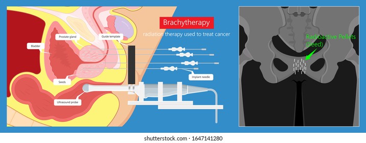 Brachytherapy Treat Vagina Cell CT Scan MRI Cervix Seed Radiotherapy Iodine Pelvic Episcleral Implant