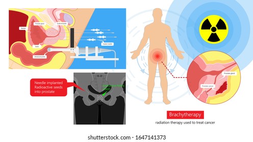 Brachytherapy Treat Vagina Cell CT Scan MRI Cervix Seed Radiotherapy Iodine Pelvic Episcleral Implant