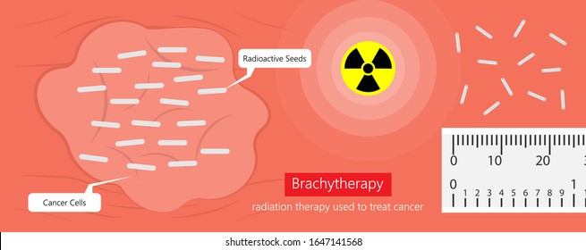 Brachytherapy Treat Vagina Cell CT Scan MRI Cervix Seed Radiotherapy Iodine Pelvic Episcleral Implant