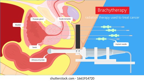 Brachytherapy Treat Vagina Cell CT Scan MRI Cervix Seed Radiotherapy Iodine Pelvic Episcleral Implant