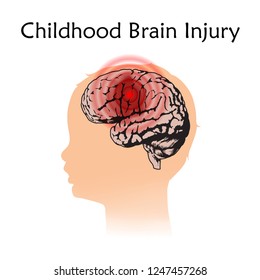 Braim Injury In Infants, Childhood. Vector Medical Illustration. Kid, Baby. White Background, Silhouette Of Child Head, Anatomy Flat Image Of Damaged Human Brain.