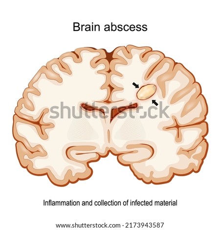 Brain abscess. Cerebral abscess. Infectious Diseases of the Brain. Cross section of a human brain with intracerebral collection of pus. Vector poster for medical use