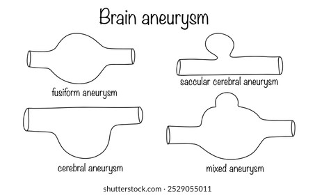 Aneurisma cerebral. Protrusão local patológica da parede fina da artéria cerebral. Principais tipos de deformação da artéria cerebral desenhados à mão. Vetor médico.