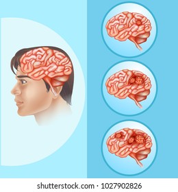 Brain cancer concept