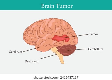 Concepto de cáncer cerebral. Las células malignas se desarrollan en el cerebro humano. Anatomía de la estructura cerebral humana. Ilustración vectorial plana