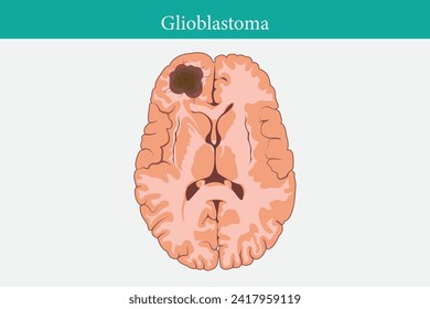 Brain cancer concept. Malignant tumor develops in the human brain. Cancer cell structure. Flat vector illustration. eps 10