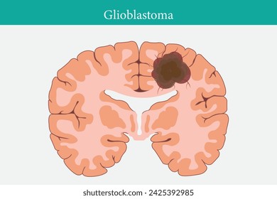 Concepto de cáncer cerebral. El tumor maligno se desarrolla en el cerebro humano. Estructura celular cancerosa. Ilustración vectorial plana. eps 10	