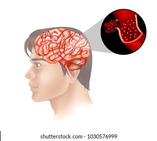 Brain cancer in human illustration