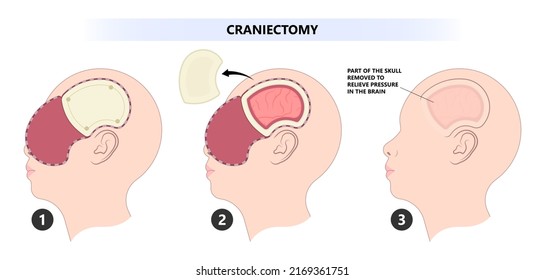 Brain cancer tumor and burr hole skull bone flap fluid head post sport accident cysts deep  stimulation Parkinson's confusion