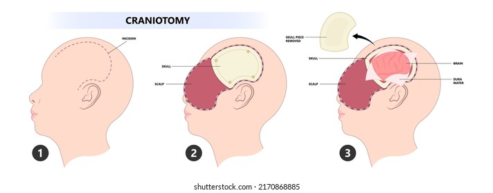 Brain cancer tumor and burr hole skull bone flap fluid head post sport accident cysts deep  stimulation Parkinson's confusion